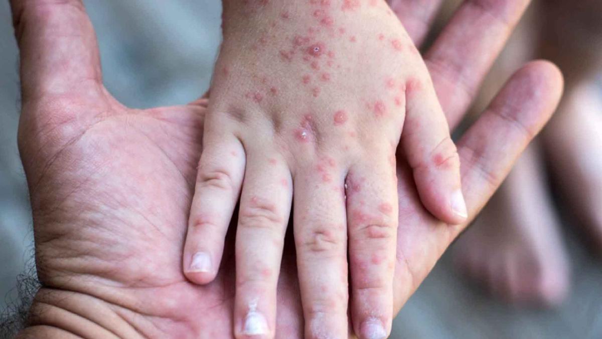 Pensilvania reporta las primeras muertes por sarampión del año en Estados Unidos